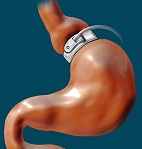 Inel gastric Gastric band