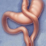 Gastric bypass Gastric by-pass