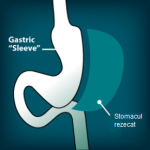 Micsorarea stomacuui Gastric sleeve
